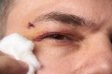 close view of a black eye, man's face with a hematoma