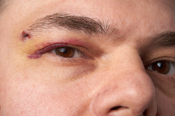 Fototapeta premium close view of a black eye, man's face with a hematoma