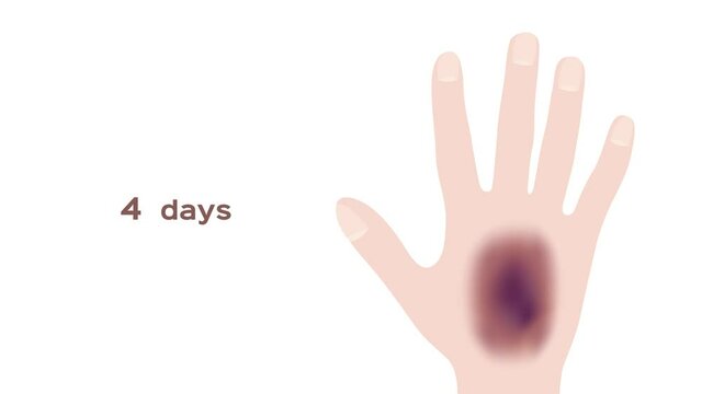 a little bit to serious bruised . It bleeding in side the hand / graphic animation 