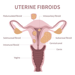 Obraz premium Reproductive system picture displays pedunculated, intracavitary, submucosal, subserosal. Isolated flat vector illustration of uterine fibroids, myoma, uterine leiomyomas on white background.