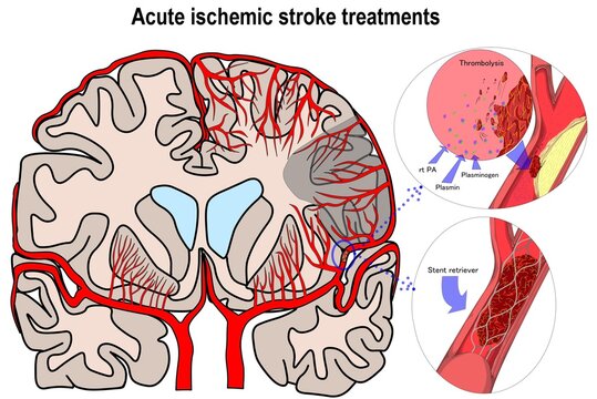 Two important choice of acute ischemic stroke treatment.