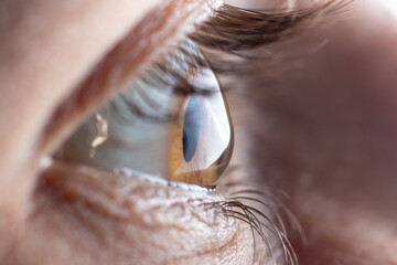 Macro eye, cornea. Ophthalmic disease keratoconus. Corneal transplant, cross-linking and Astigmatism.