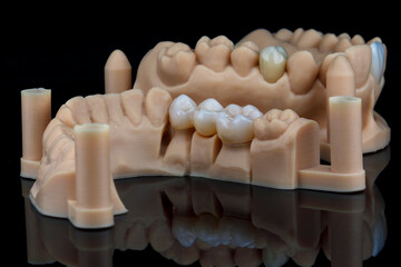 beautifully laid out dental models and zircon crowns mounted on models on a black background - obrazy, fototapety, plakaty