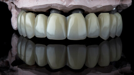 temporary dental prosthesis of the upper jaw made on a polymer milling cutter on a gypsum model, shot on a black background with reflection © Dental Pro Content