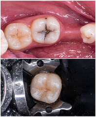 before and after pictures for tooth restoration by composite
