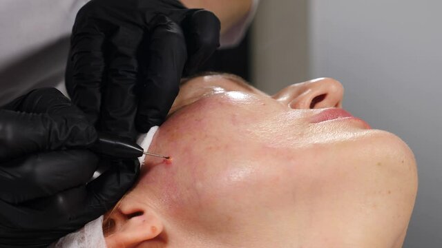 Electrocoagulation of papillomas. Female beautician removing mole in surgical procedure by burning it with medical tools and equipment on face skin. 4 k video