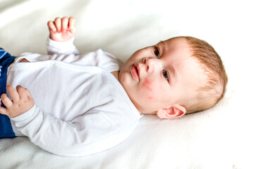 Atopic dermatitis eczema in baby.Condition that causes the skin to become red,dry,sore,itchy and cracked.Atopic eczema most often affects face in children