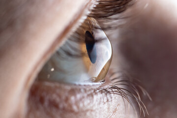 Macro eye photo. Keratoconus - eye disease, thinning of the cornea in the form of a cone. The...
