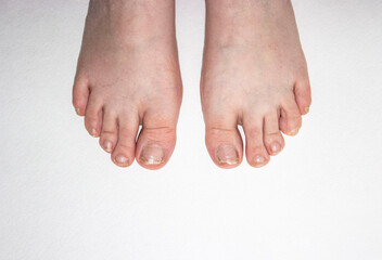 Feet with damaged nails, no pedicure. Regrown toenails and cuticles. Female teenagers, small size. On a solid white background. A disease of the nail plate by a fungus.