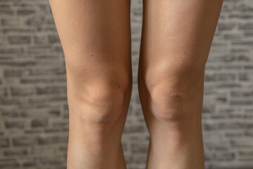 knees of a young white-skinned girl with a scar closeup
