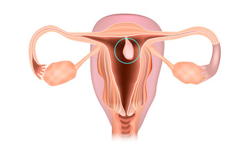 Endometrial polyp or uterine polyp. - obrazy, fototapety, plakaty