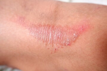 Obraz premium Bad skin condition in knee because of poison liquid of dangerous insect, name tomcat or Paedarus littorals or rove beetle, cause hurt, pain, hot and burn effect. Red red rash and keloid skin scar