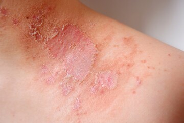 Fototapeta premium Bad skin condition because of poison liquid of dangerous insect, name tomcat or Paedarus littorals or rove beetle, cause hurt, pain, hot and burn effect. Red red rash and skin peeling off after days 