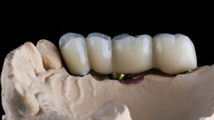 Fototapeta na wymiar ceramic dental bridge a small prosthesis for the chewing part of the jaw after implantation, shot on a model of gypsum with a black background