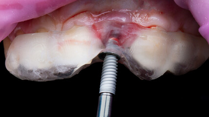 implantation through a surgical implant template for restoration of a central incisor