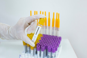 Coronavirus COVID-19 positive case blood test tube close-up in medical laboratory