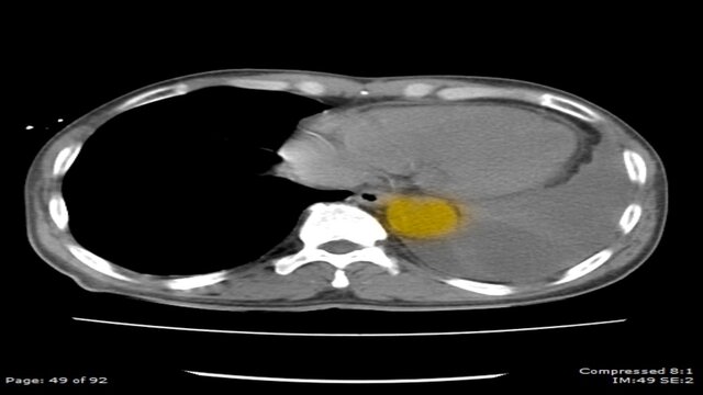 CT scan body image Axial view with yellow mark show abnormal enlargement of the aorta4 