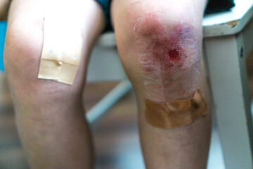Fototapeta premium Wunde am Knie