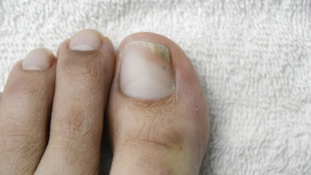 Adult man scratching toe with fungus on white towel when leaving the pool