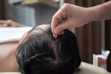 Acupuncture to the head .hair Glabrous