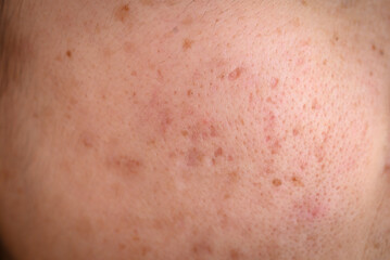 Woman face has variety problems on her skin (such as Acne, Pimple, Pores and Melasma etc).