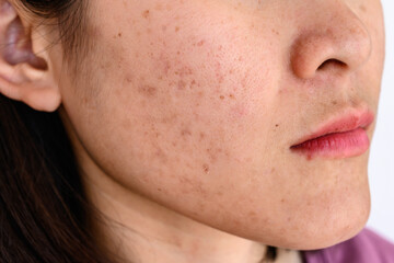 Woman face has variety problems on her skin (such as Acne, Pimple, Pores and Melasma etc).