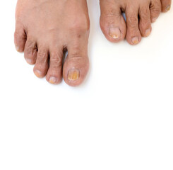 Discolouration of nails after chemotherapy. Side effects from breast cancer treatment.