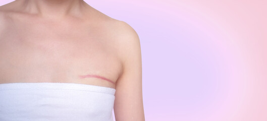 Breast cancer surgery scars by partial mastectomy.  She can wear a tube top or tube dress and strapless with confident. With effect filter. - obrazy, fototapety, plakaty