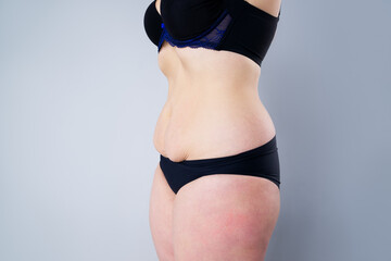 Tummy tuck, flabby skin on a fat belly, plastic surgery concept