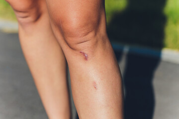 Close up of female knee with a scar.
