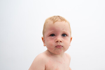 Boy with allergic rash or eczema on face and body