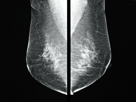 Textured image of bilateral mammography of both breasts on black background