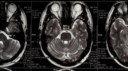 Brain MRI slide of a young man