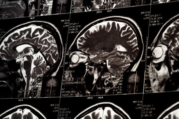 MRI scan of human brain