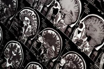 MRI scan of human brain