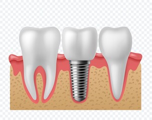 Tooth implant. Human teeth and dental implant, denture orthodontic technology. Artificial teeth dentistry implantation jaw vector concept