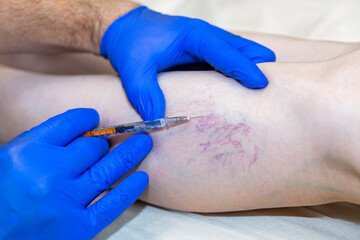 Fototapeta na wymiar Laser treatment of varicose veins on the leg with anesthesia