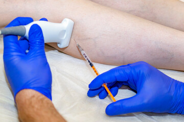 Laser treatment of varicose veins on the leg with anesthesia
