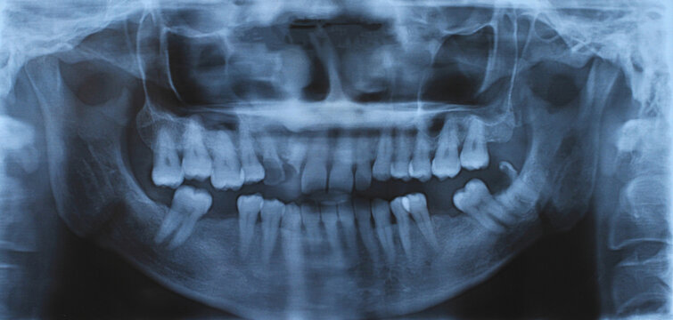 Panoramic dental and mandible x-ray image