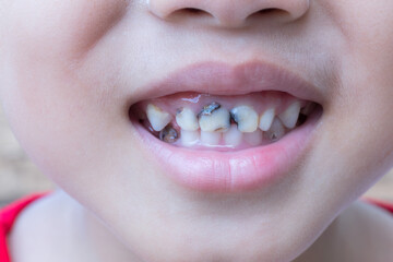 Asian little boy with decayed teeth with smiling