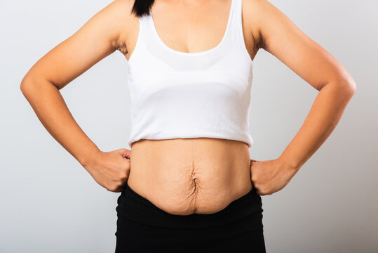 Close up of Asian mother woman showing stretch mark loose lower abdomen skin she fat after pregnancy baby birth, studio isolated on white background, Healthy belly overweight excess body concept