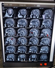 CT scan of sagittal section of head