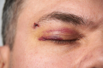 Obraz premium close view of a black eye, man's face with a hematoma