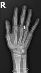 X-Ray hand show bullet in hand male 16-year-old