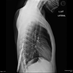X-Ray show knife in back lateral
