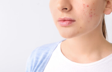 Young woman with acne problem on light background