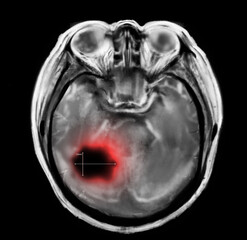X-ray of patient with brain cancer. Illustration