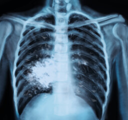 X-ray of patient with lung cancer. Illustration