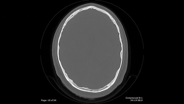CT scan axial view with bullet fragmentation in brain male 20 year old