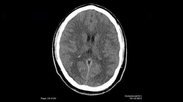 CT scan axial view with bullet fragmentation in brain male 20-year-old